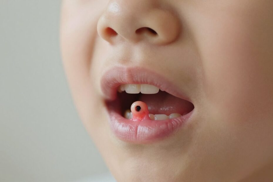 Przetoka na dziąśle u dziecka