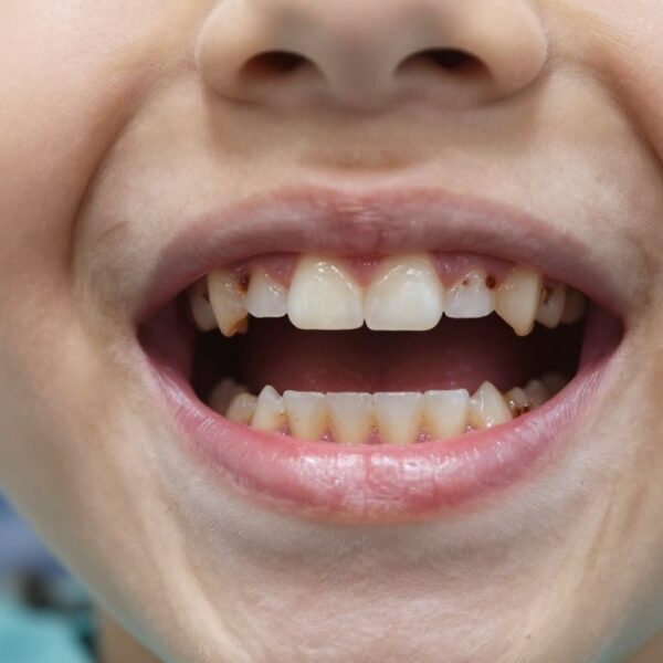 Czy wyrywać zęby mleczne z próchnicą