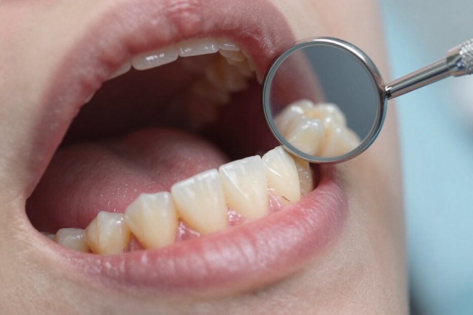 Dziąsło odchodzi od zęba